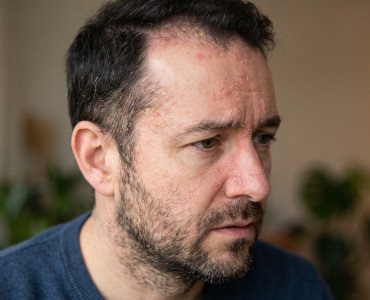 Себорейний дерматит: причини, симптоми і лікування